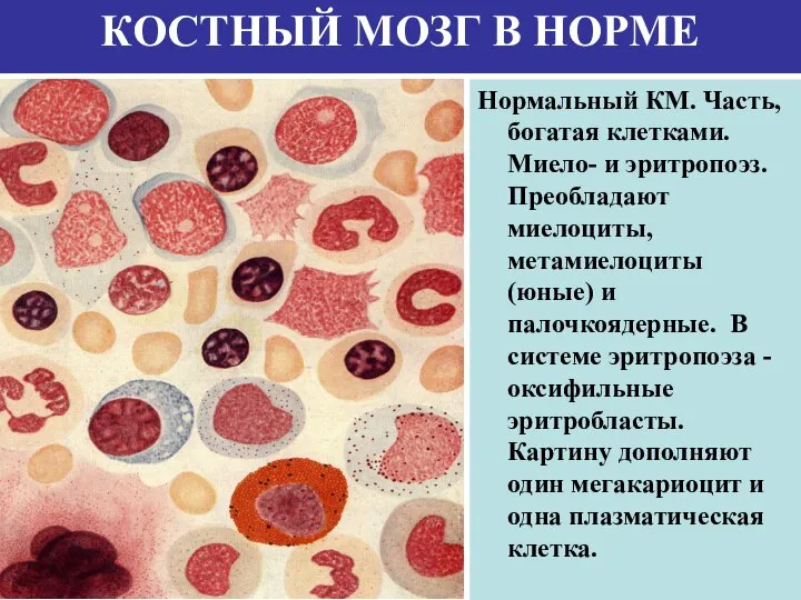 КОСТНЫЙ МОЗГ В НОРМЕ Нормальный КМ. Часть, богатая клетками. Миело- и