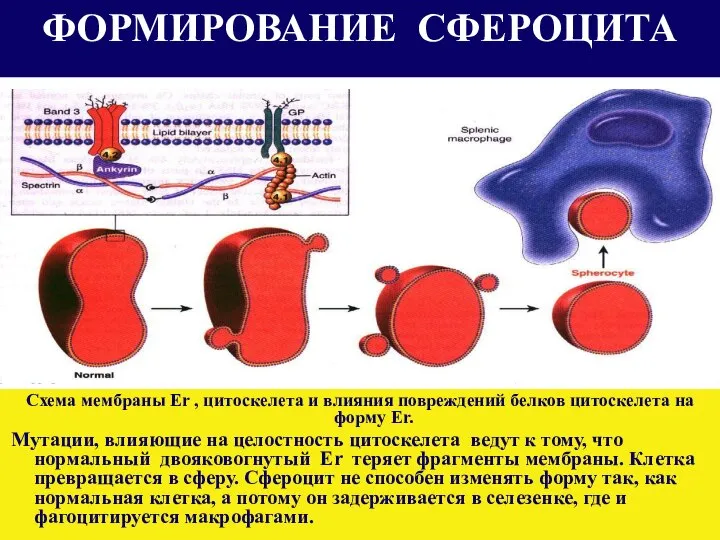 ФОРМИРОВАНИЕ СФЕРОЦИТА Схема мембраны Er , цитоскелета и влияния повреждений белков