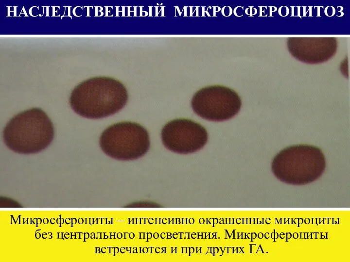 НАСЛЕДСТВЕННЫЙ МИКРОСФЕРОЦИТОЗ Микросфероциты – интенсивно окрашенные микроциты без центрального просветления. Микросфероциты встречаются и при других ГА.