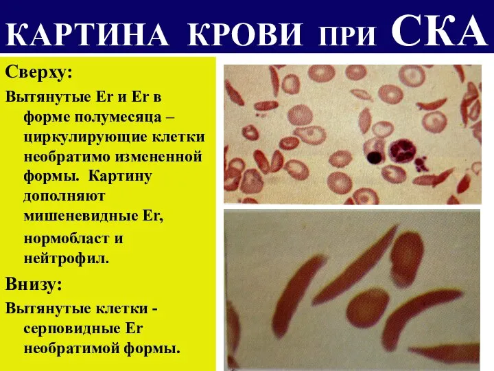 КАРТИНА КРОВИ ПРИ СКА Сверху: Вытянутые Er и Er в форме