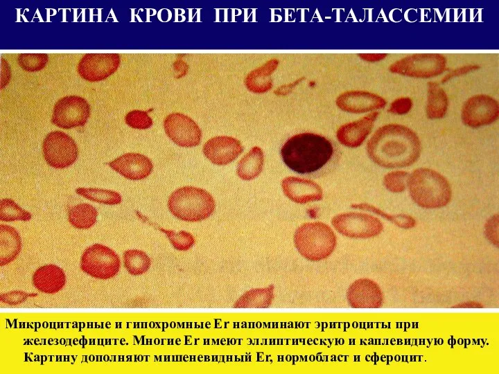 КАРТИНА КРОВИ ПРИ БЕТА-ТАЛАССЕМИИ Микроцитарные и гипохромные Er напоминают эритроциты при