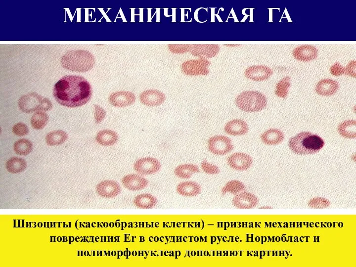 МЕХАНИЧЕСКАЯ ГА Шизоциты (каскообразные клетки) – признак механического повреждения Er в