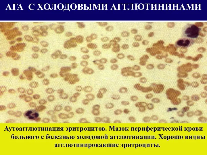 АГА С ХОЛОДОВЫМИ АГГЛЮТИНИНАМИ Аутоагглютинация эритроцитов. Мазок периферической крови больного с