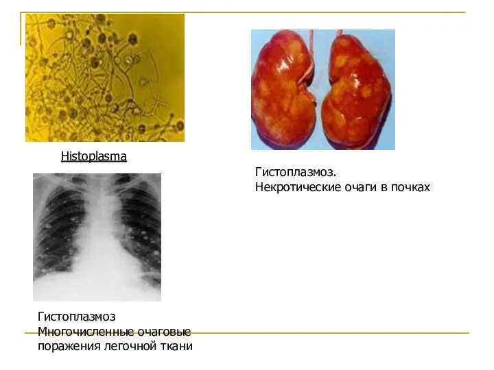 Histoplasma Гистоплазмоз. Некротические очаги в почках Гистоплазмоз Многочисленные очаговые поражения легочной ткани