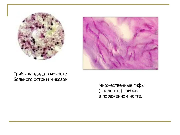 Грибы кандида в мокроте больного острым микозом Множественные гифы (элементы) грибов в пораженном ногте.