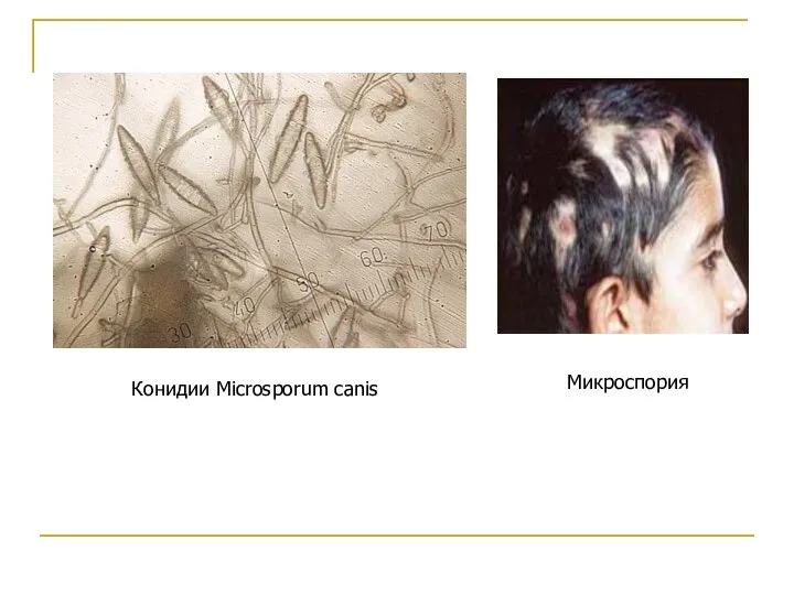 Конидии Microsporum canis Микроспория