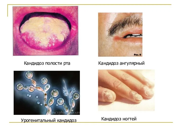 Кандидоз полости рта Кандидоз ангулярный Урогенитальный кандидоз Кандидоз ногтей