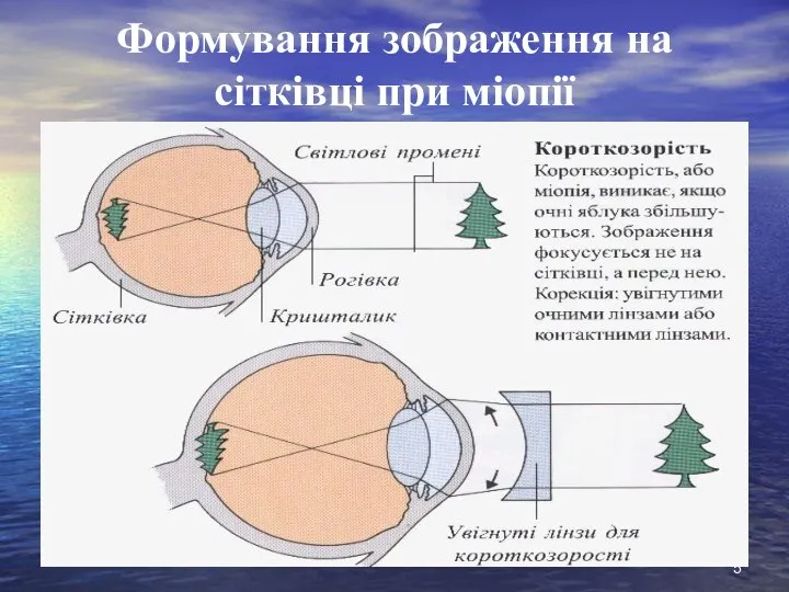 Формування зображення на сітківці при міопії