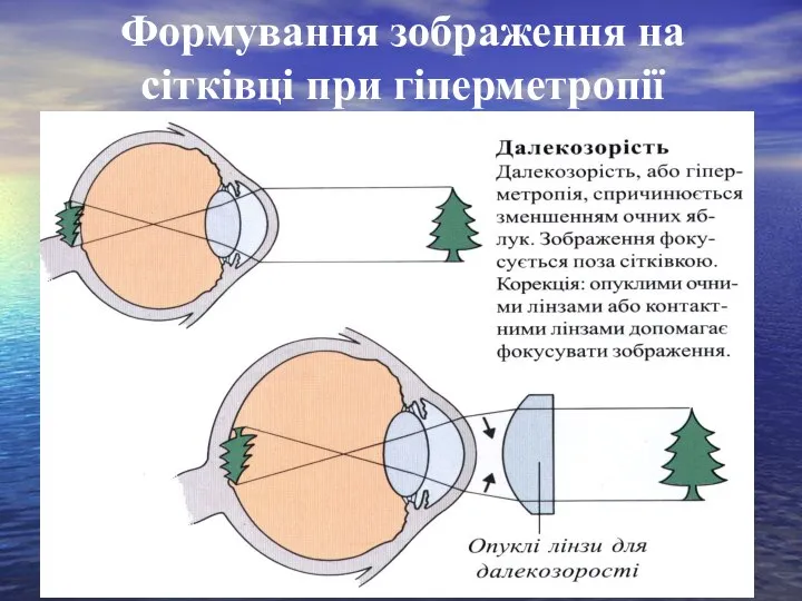 Формування зображення на сітківці при гіперметропії