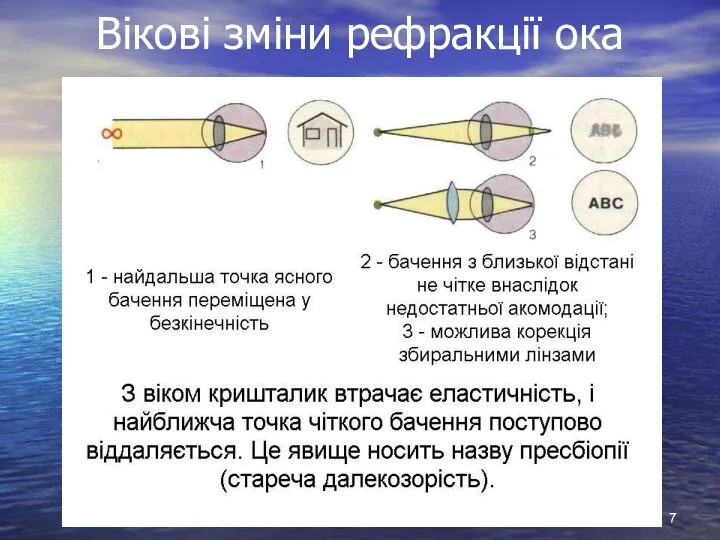 Вікові зміни рефракції ока