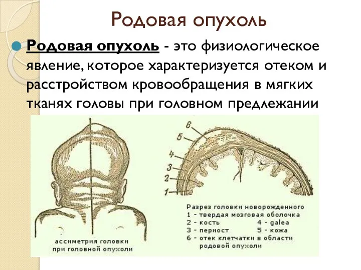 Родовая опухоль Родовая опухоль - это физиологическое явление, которое характеризуется отеком