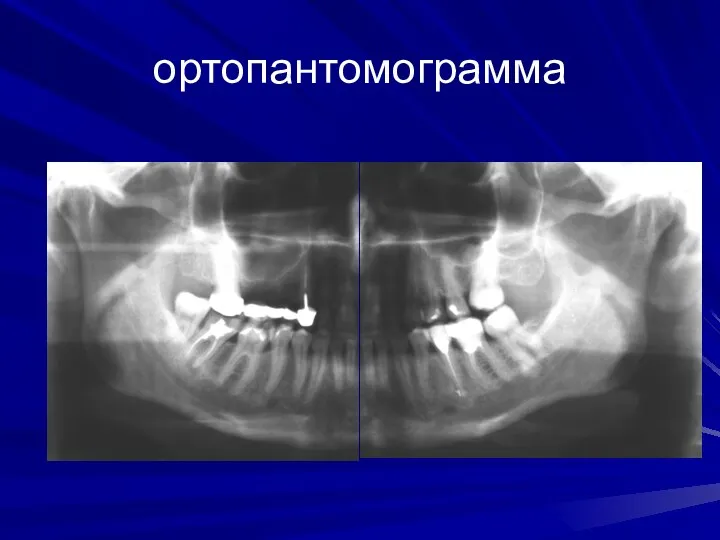 ортопантомограмма