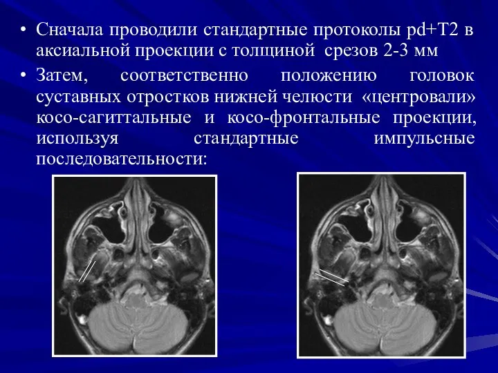 Сначала проводили стандартные протоколы pd+T2 в аксиальной проекции с толщиной срезов