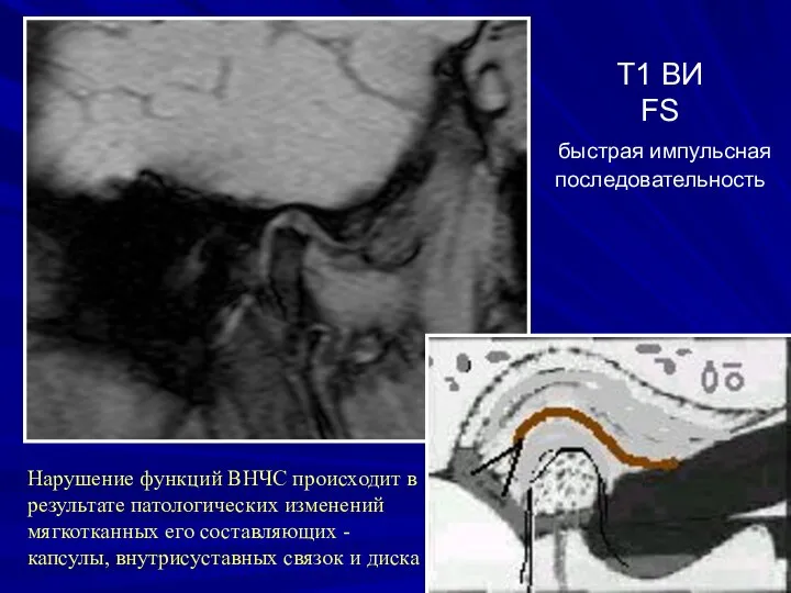 Т1 ВИ FS быстрая импульсная последовательность Нарушение функций ВНЧС происходит в