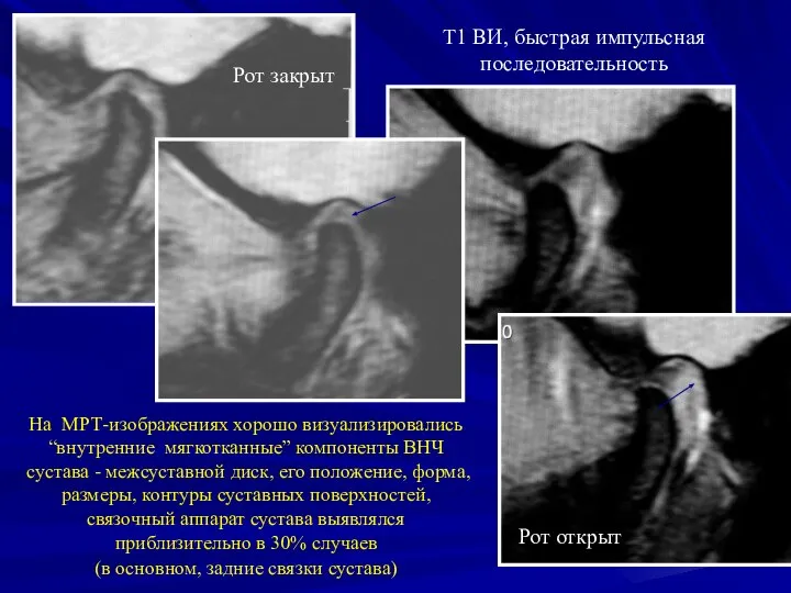На МРТ-изображениях хорошо визуализировались “внутренние мягкотканные” компоненты ВНЧ сустава - межсуставной