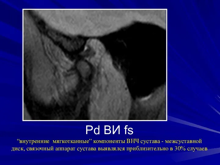 Pd ВИ fs “внутренние мягкотканные” компоненты ВНЧ сустава - межсуставной диск,