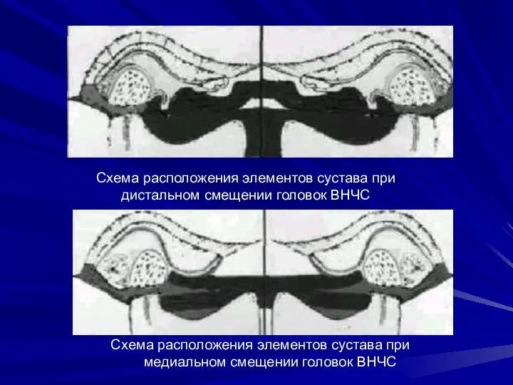 Схема расположения элементов сустава при дистальном смещении головок ВНЧС Схема расположения