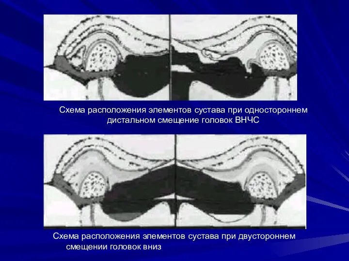 Схема расположения элементов сустава при одностороннем дистальном смещение головок ВНЧС Схема