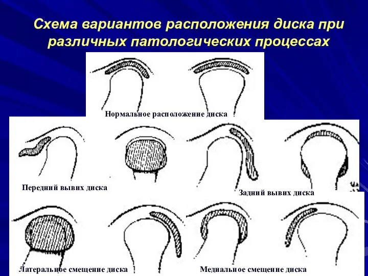 Схема вариантов расположения диска при различных патологических процессах Нормальное расположение диска