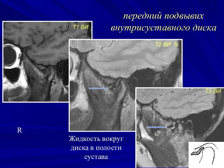 передний подвывих внутрисуставного диска R Т1 ВИ Т2 ВИ fs Т2