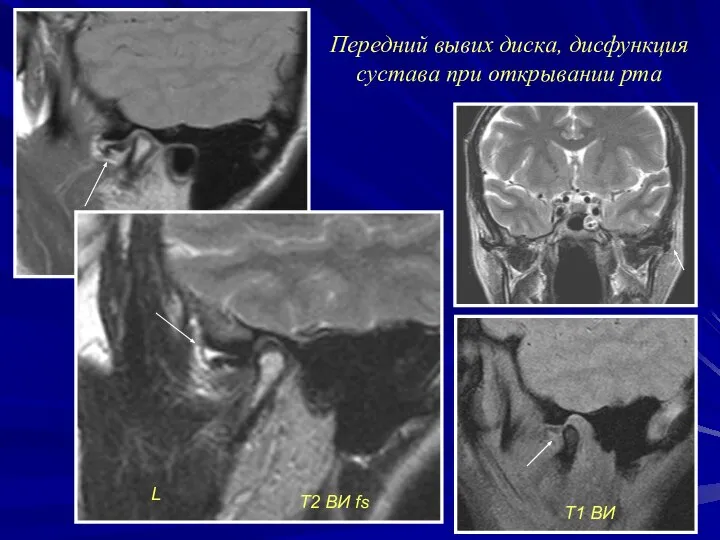 Передний вывих диска, дисфункция сустава при открывании рта L Т2 ВИ fs Т1 ВИ