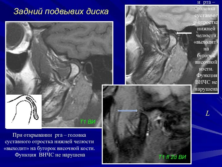 Задний подвывих диска L При открывании рта – головка суставного отростка