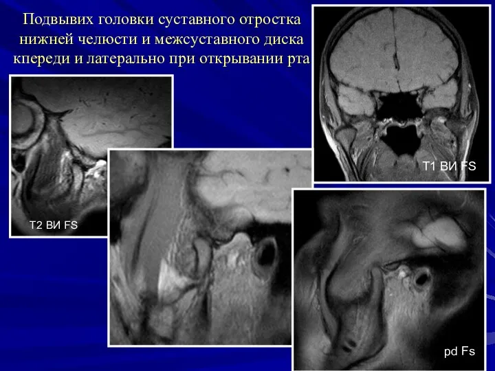 Подвывих головки суставного отростка нижней челюсти и межсуставного диска кпереди и