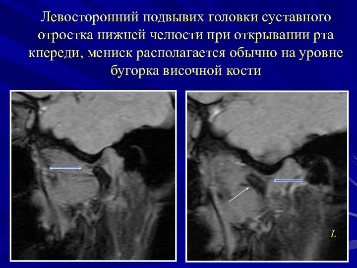 Левосторонний подвывих головки суставного отростка нижней челюсти при открывании рта кпереди,