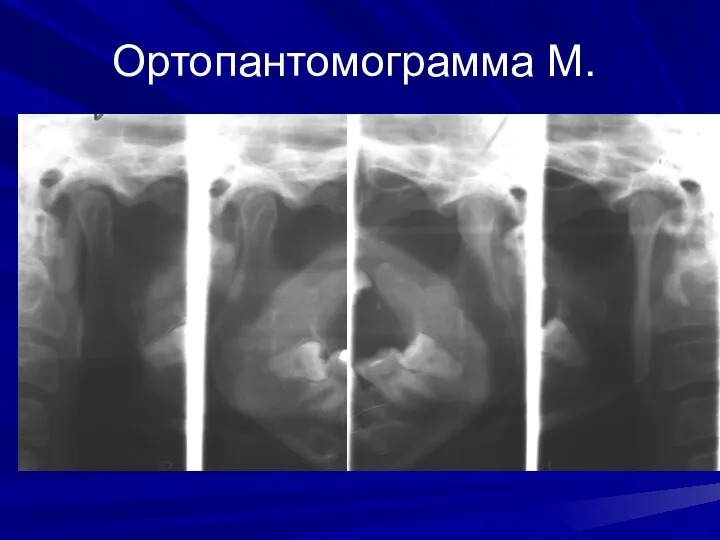 Ортопантомограмма М.