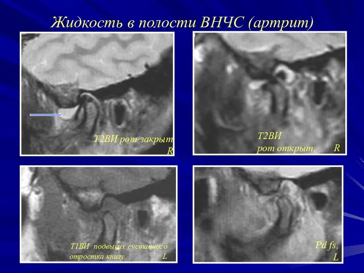 Жидкость в полости ВНЧС (артрит) T2ВИ рот закрыт R Pd fs,