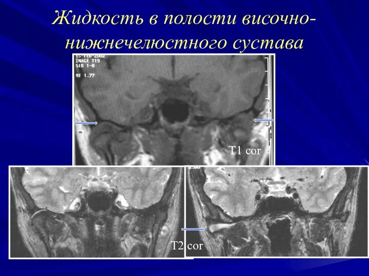 Жидкость в полости височно-нижнечелюстного сустава Т1 cor Т2 cor