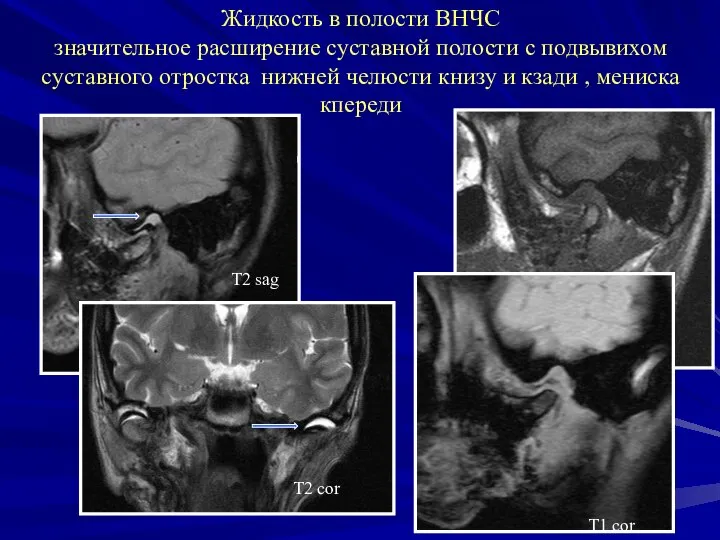 Жидкость в полости ВНЧС значительное расширение суставной полости с подвывихом суставного