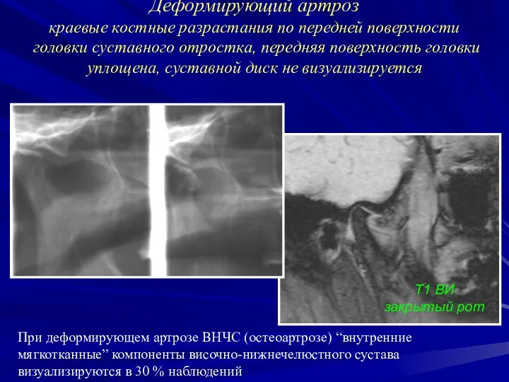 Деформирующий артроз краевые костные разрастания по передней поверхности головки суставного отростка,