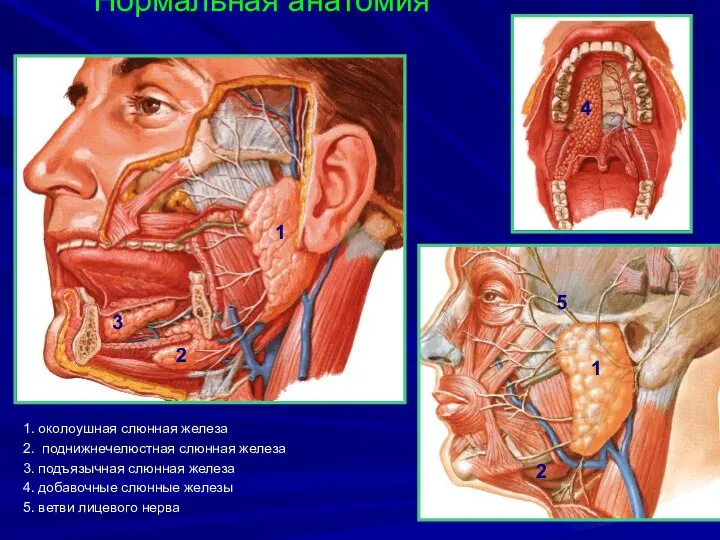Нормальная анатомия 1. околоушная слюнная железа 2. поднижнечелюстная слюнная железа 3.
