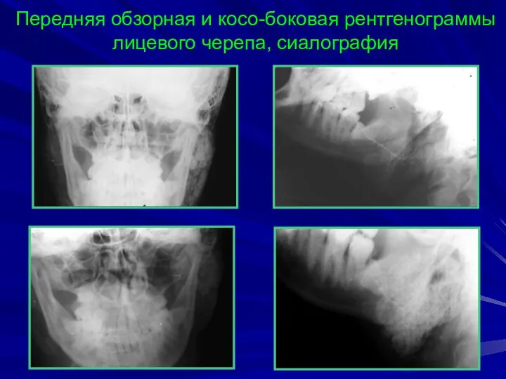Передняя обзорная и косо-боковая рентгенограммы лицевого черепа, сиалография