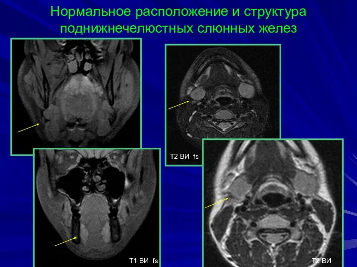 Нормальное расположение и структура поднижнечелюстных слюнных желез T1 BИ fs T2 BИ fs T2 BИ