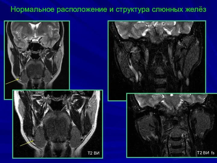 Нормальное расположение и структура слюнных желёз T2 BИ T2 BИ fs