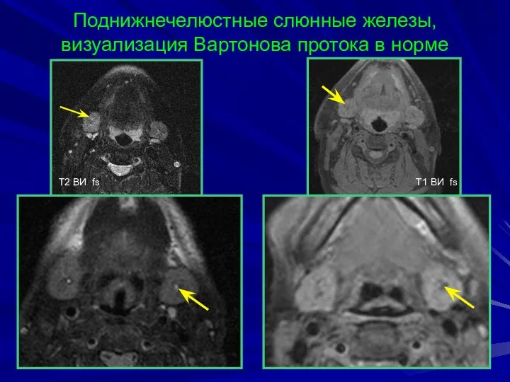 Поднижнечелюстные слюнные железы, визуализация Вартонова протока в норме T2 BИ fs T1 BИ fs