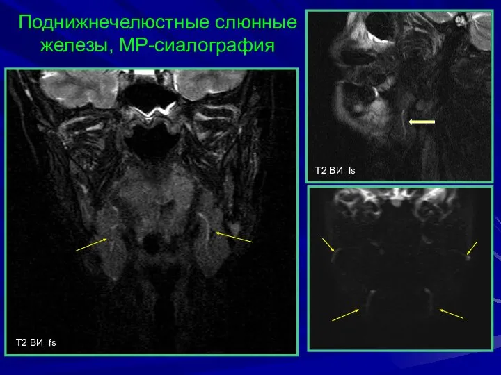 T2 BИ fs Поднижнечелюстные слюнные железы, МР-сиалография T2 BИ fs