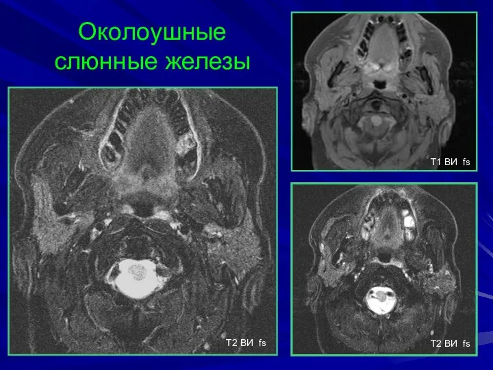 Околоушные слюнные железы T2 BИ fs T1 BИ fs T2 BИ fs