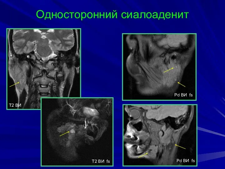 Односторонний сиалоаденит T2 BИ T2 BИ fs Pd BИ fs Pd BИ fs