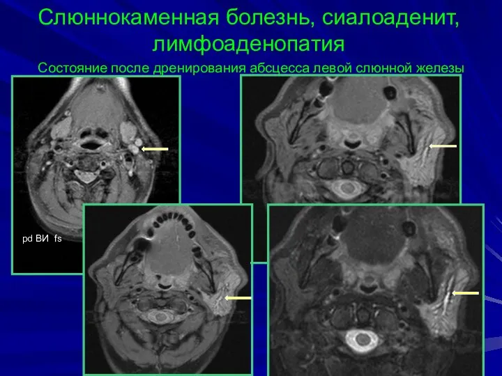 pd BИ fs Слюннокаменная болезнь, сиалоаденит, лимфоаденопатия Состояние после дренирования абсцесса левой слюнной железы