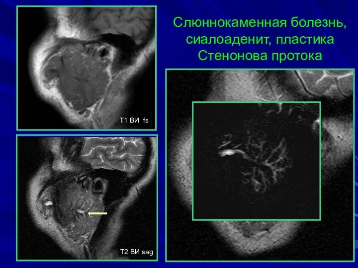 Слюннокаменная болезнь, сиалоаденит, пластика Стенонова протока T1 BИ fs T2 BИ sag