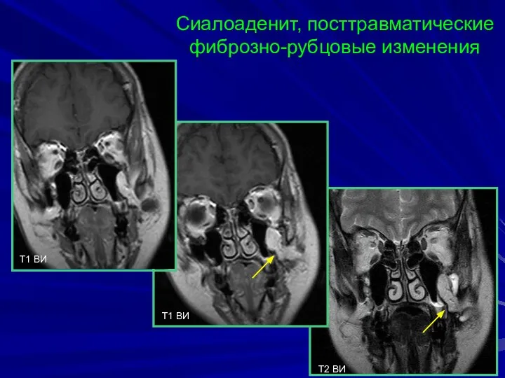 Сиалоаденит, посттравматические фиброзно-рубцовые изменения T1 BИ T1 BИ T2 BИ