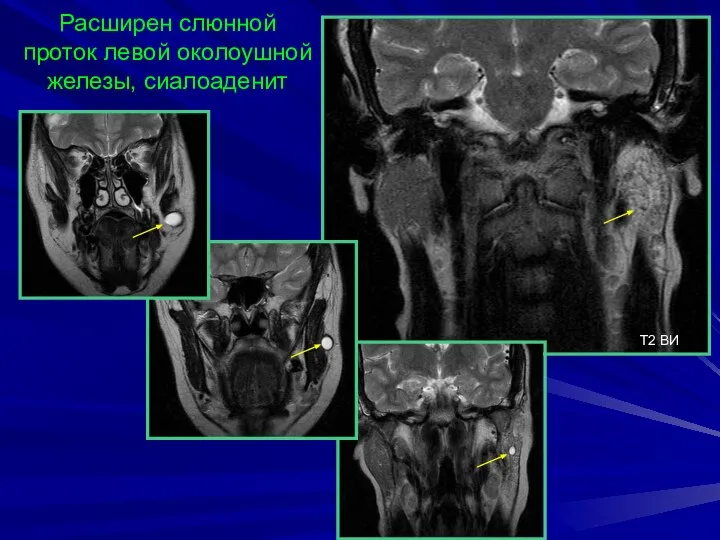 Расширен слюнной проток левой околоушной железы, сиалоаденит T2 BИ