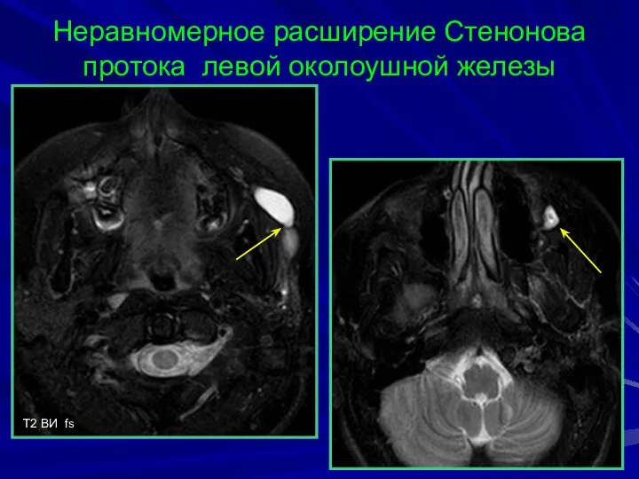 Неравномерное расширение Стенонова протока левой околоушной железы T2 BИ fs