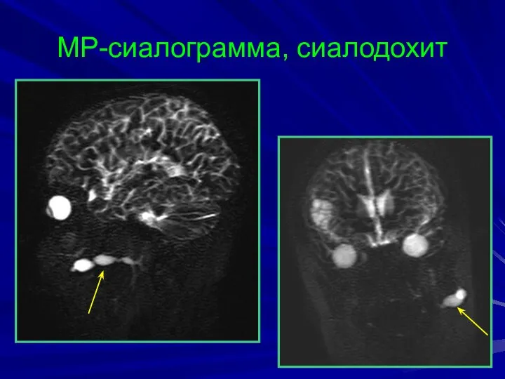 МР-сиалограмма, сиалодохит