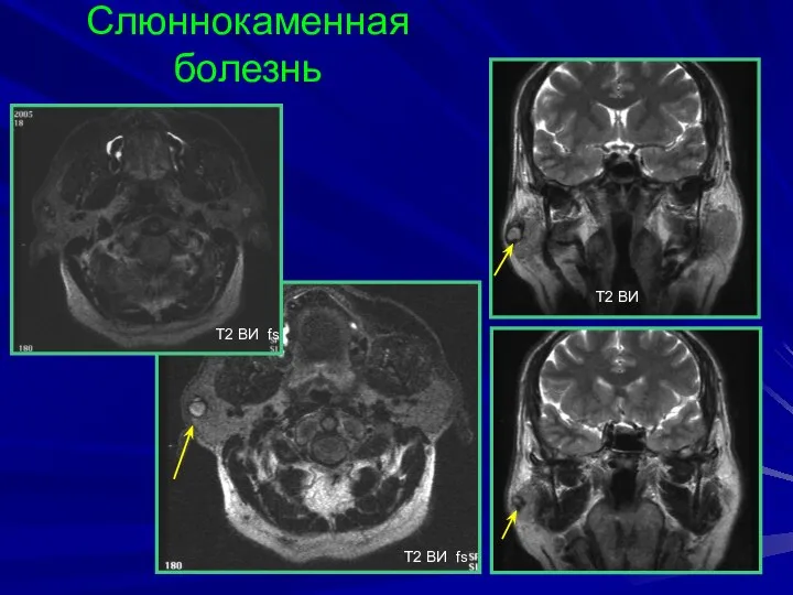 Слюннокаменная болезнь T2 BИ fs T2 BИ fs T2 BИ