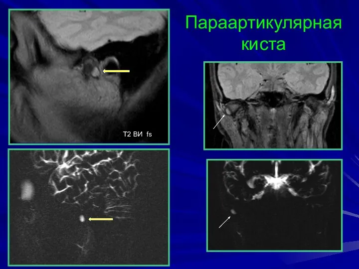 Параартикулярная киста T2 BИ fs