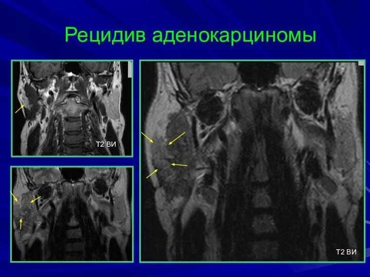 Рецидив аденокарциномы T2 BИ T2 BИ